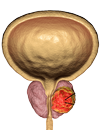 Удаления простаты при раке — какие последствия ждут больного после операции