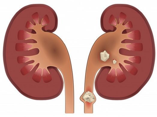 Камни обеих почек: подбираем эффективное лечение малоинвазивными методами
