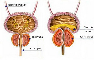 Гиперплазия (аденома) предстательной железы